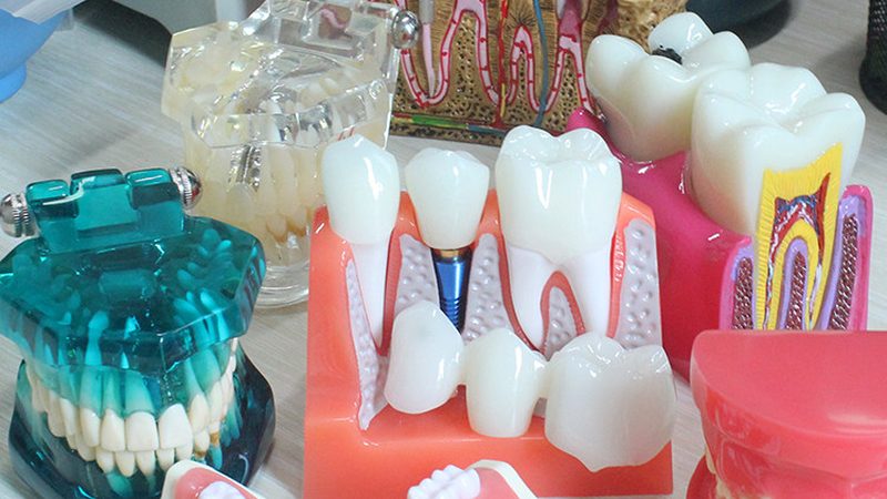 揭秘隐形牙套：十大品牌型号背后的参数解析
